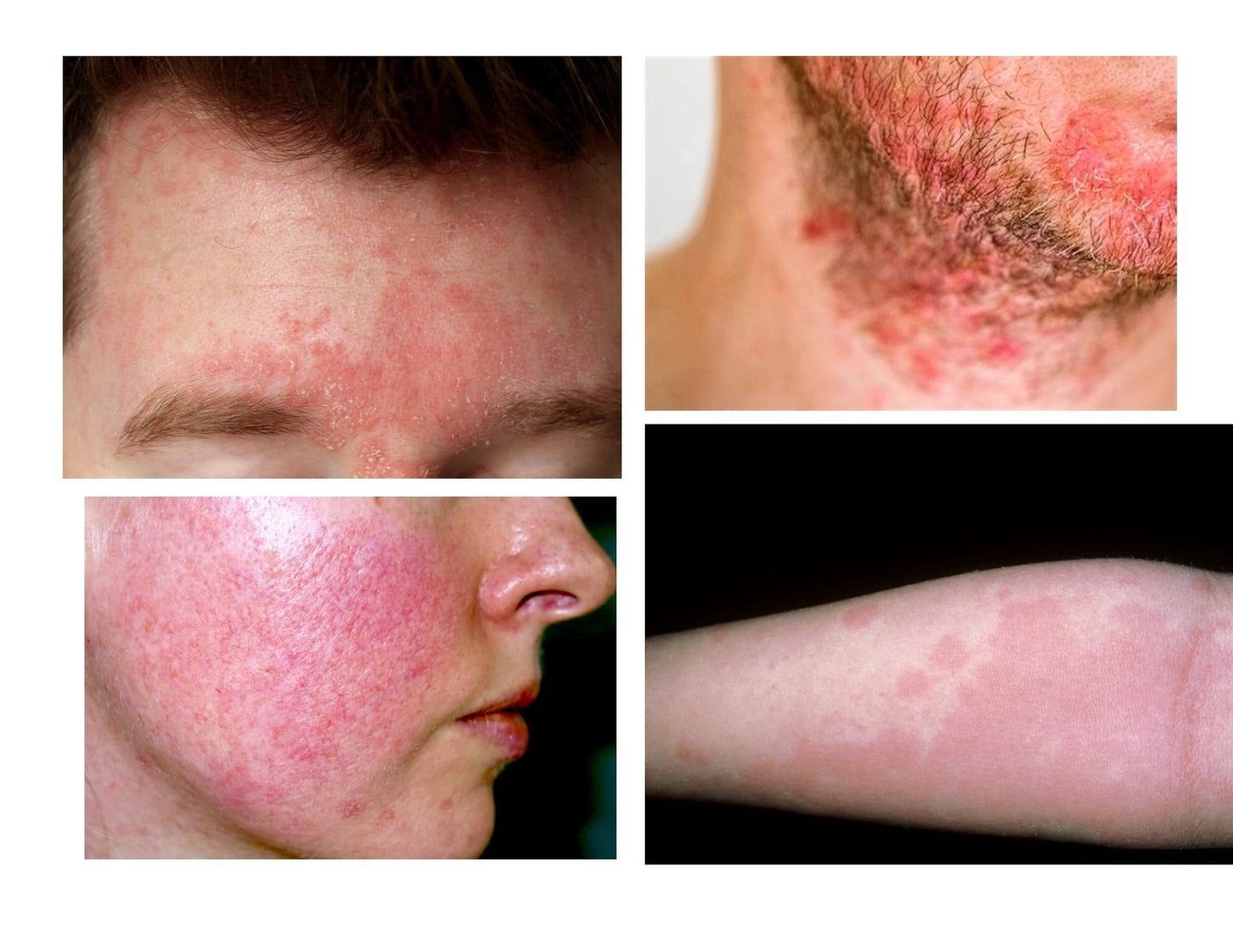 INFLAMED SKIN CONDITION PACKAGE